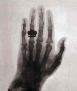 worlds-first-x-ray-1895-rontgens-wife-hand