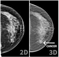 2d v 3d mammogram